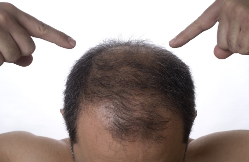 seanleedsuk-hair-loss